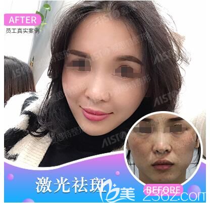 范紅梅醫(yī)生激光祛斑案例對比照 范紅梅醫(yī)生激光祛斑案例對比照