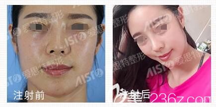 高飛注射瘦臉+玻尿酸豐蘋(píng)果機(jī)對(duì)比案例 高飛注射瘦臉+玻尿酸豐蘋(píng)果機(jī)對(duì)比案例