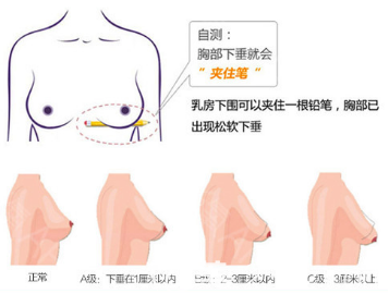 檢測乳房是否下垂的示意圖 檢測乳房是否下垂的示意圖