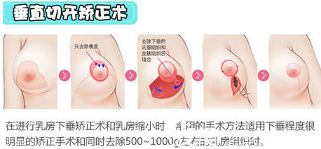 垂直切開矯正乳房下垂手術(shù)示意圖 垂直切開矯正乳房下垂手術(shù)示意圖