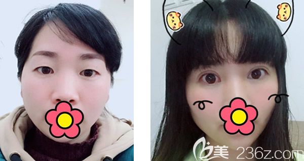 呼和浩特五洲王煥割雙眼皮怎么樣 呼和浩特五洲王煥割雙眼皮怎么樣