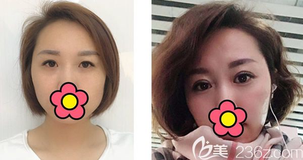 呼市五洲王煥內(nèi)雙割雙眼皮效果案例 呼市五洲王煥內(nèi)雙割雙眼皮效果案例