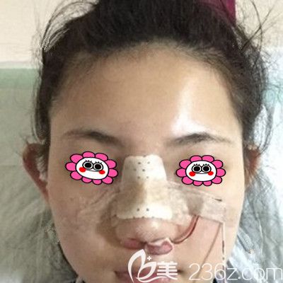 肋軟骨隆鼻當天照片 肋軟骨隆鼻當天照片