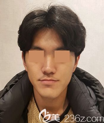 在韓國(guó)faceline做面部輪廓手術(shù)前 在韓國(guó)faceline做面部輪廓手術(shù)前