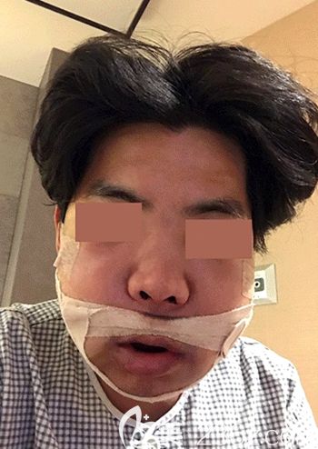 在韓國(guó)faceline做面部輪廓手術(shù)后3天 在韓國(guó)faceline做面部輪廓手術(shù)后3天