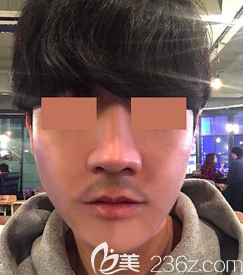 在韓國(guó)faceline做面部輪廓手術(shù)后1個(gè)月 在韓國(guó)faceline做面部輪廓手術(shù)后1個(gè)月