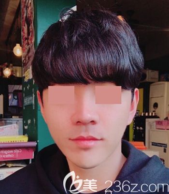 在韓國(guó)faceline做面部輪廓手術(shù)后3個(gè)月 在韓國(guó)faceline做面部輪廓手術(shù)后3個(gè)月