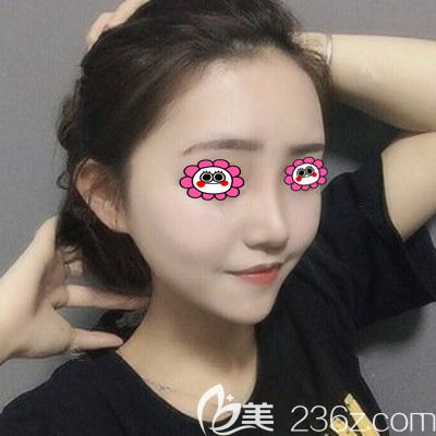 半年前在找符恒做肋軟骨隆鼻，秀一波我的側顏殺