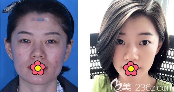 呼和浩特五洲整形做自體脂肪面部填充效果怎么樣 求美者是這樣說的