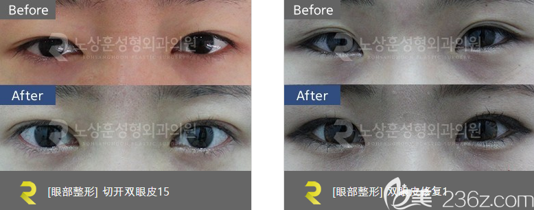 盧相勛眼部整形案例 盧相勛眼部整形案例