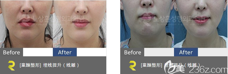 盧相勛埋線提升整形案例 盧相勛埋線提升整形案例