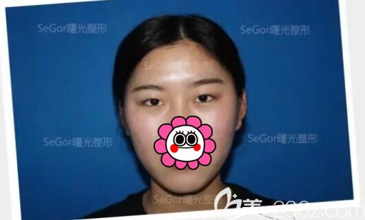 面診常州曙光術(shù)前單眼皮 面診常州曙光術(shù)前單眼皮