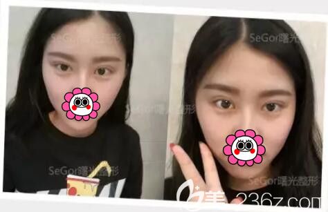 一周拆線后韓式雙眼皮恢復中 一周拆線后韓式雙眼皮恢復中