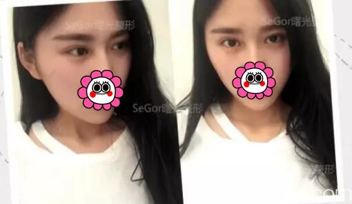 韓式切開(kāi)雙眼皮的真實(shí)過(guò)程及恢復(fù)體驗(yàn)：期待一下常州曙光田文清醫(yī)生0.1mm切口的術(shù)后效果