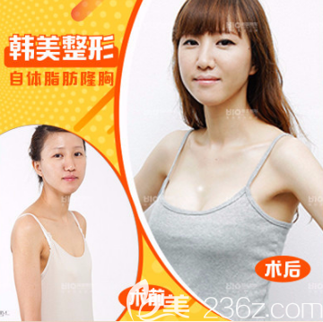 濟寧韓美自體脂肪隆胸