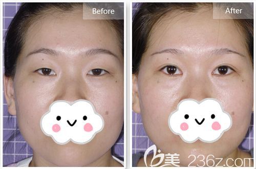 唐山蘇亞美聯(lián)臣做雙眼皮案例 唐山蘇亞美聯(lián)臣做雙眼皮案例