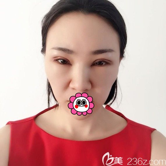 黑龍江瑞麗眼綜合手術(shù)5天效果 黑龍江瑞麗眼綜合手術(shù)5天效果