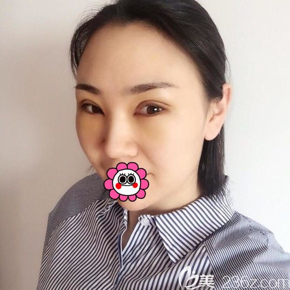 這是我到黑龍江瑞麗找楊永勝做的眼綜合手術(shù)，分享我體驗(yàn)手術(shù)前的心理和術(shù)后恢復(fù)經(jīng)歷給猶豫不定的你一些參考