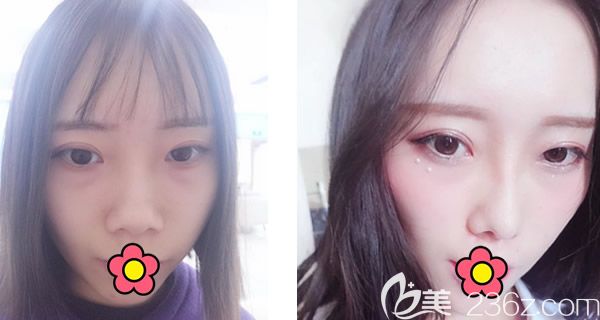 呼市五洲王煥自體肋軟骨綜合隆鼻案例 呼市五洲王煥自體肋軟骨綜合隆鼻案例