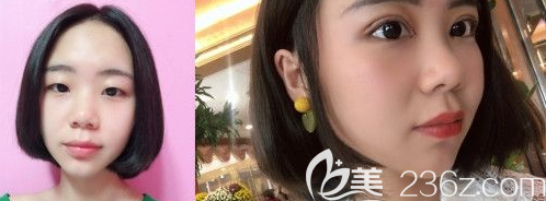 盧相勛整形醫(yī)院雙眼皮真人案例 盧相勛整形醫(yī)院雙眼皮真人案例