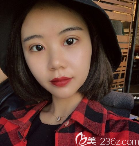 盧相勛提肌開(kāi)眼角案例 盧相勛提肌開(kāi)眼角案例