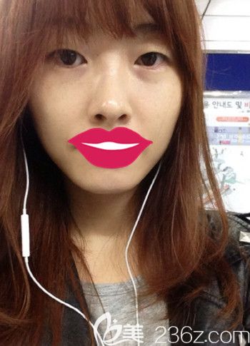 我在韓國(guó)S-ONE整形外科做面部脂肪填充+眼鼻整形后2個(gè)月就擁有了好看的小臉