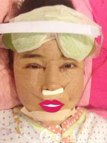 我在韓國S-ONE整形外科做面部脂肪填充+眼鼻整形+豐下巴當(dāng)天 我在韓國S-ONE整形外科做面部脂肪填充+眼鼻整形+豐下巴當(dāng)天