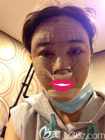 我在韓國S-ONE整形外科做面部脂肪填充+眼鼻整形+豐下巴第二天 我在韓國S-ONE整形外科做面部脂肪填充+眼鼻整形+豐下巴第二天