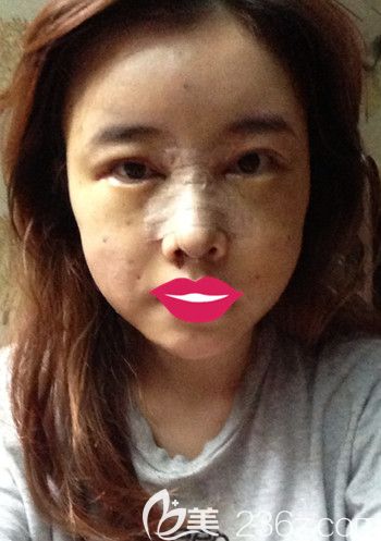 我在韓國S-ONE整形外科做面部脂肪填充+眼鼻整形+豐下巴第3天 我在韓國S-ONE整形外科做面部脂肪填充+眼鼻整形+豐下巴第3天