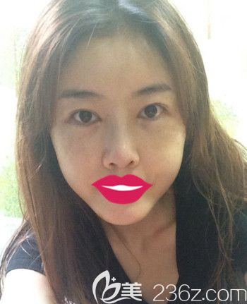 我在韓國S-ONE整形外科做面部脂肪填充+眼鼻整形+豐下巴后2周 我在韓國S-ONE整形外科做面部脂肪填充+眼鼻整形+豐下巴后2周