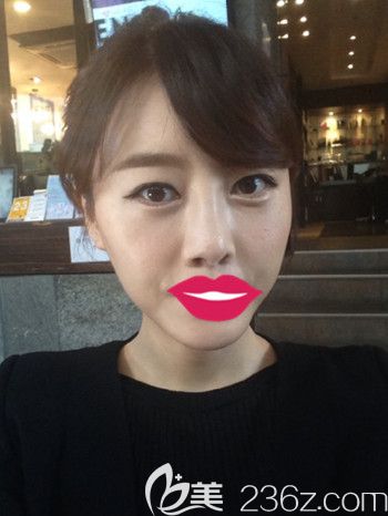 我在韓國S-ONE整形外科做面部脂肪填充+眼鼻整形+豐下巴后2個(gè)月 我在韓國S-ONE整形外科做面部脂肪填充+眼鼻整形+豐下巴后2個(gè)月