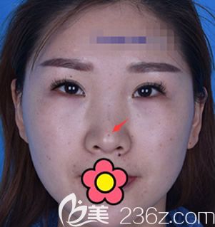 呼和浩特五洲整形隆鼻失敗修復(fù)前 呼和浩特五洲整形隆鼻失敗修復(fù)前