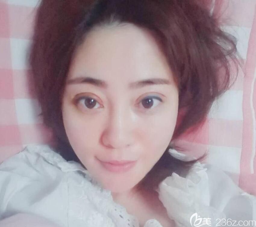 白領(lǐng)安琪兒全臉線雕+玻尿酸填充淚溝+眼綜合7天拆線照片