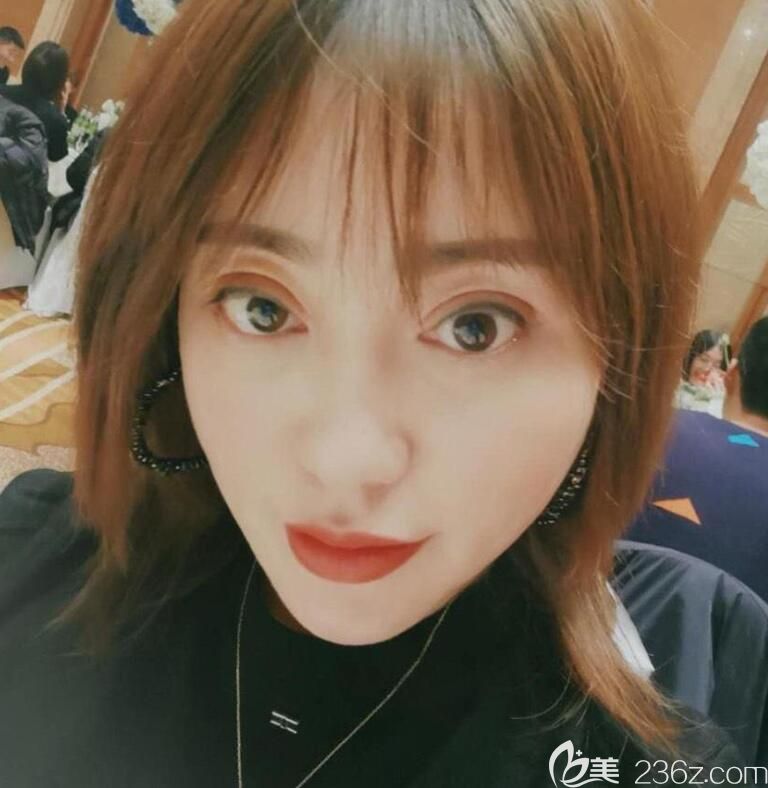 合肥白領(lǐng)安琪兒全臉線雕+玻尿酸填充淚溝+眼綜合7天 圖