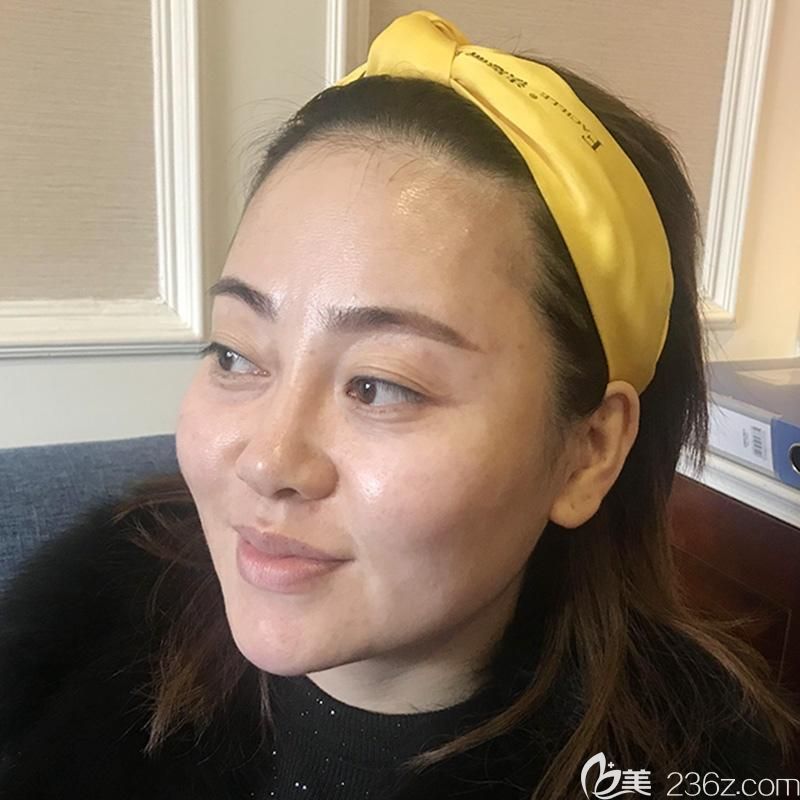 眼綜合+全臉線雕+玻尿酸填充淚溝前側(cè)面