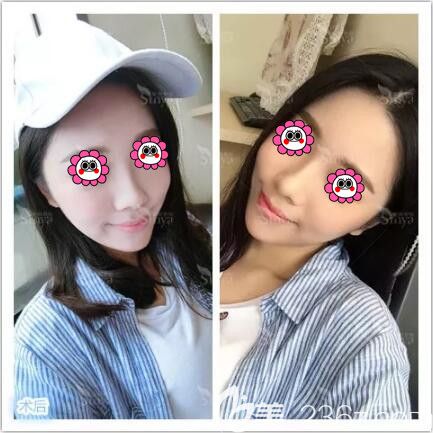 做假體墊下巴術(shù)后一周拆線