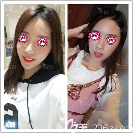 在長(zhǎng)沙做假體墊下巴一個(gè)月效果