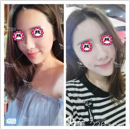 在長(zhǎng)沙星雅做假體豐下巴一個(gè)半月恢復(fù)效果