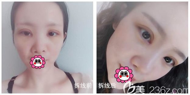 雙眼皮修復(fù)拆線前后