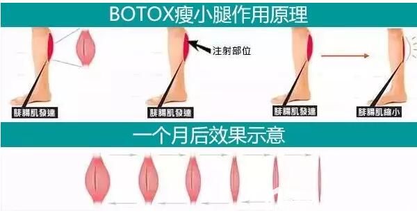 瘦臉除皺瘦腿作用原理及術(shù)后一月效果 瘦臉除皺瘦腿作用原理及術(shù)后一月效果