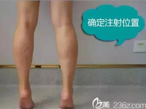 術(shù)前墊腳確定注射瘦臉除皺位置 術(shù)前墊腳確定注射瘦臉除皺位置