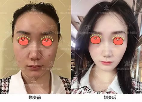 紹興維美李俊霞面部線雕案例 紹興維美李俊霞面部線雕案例