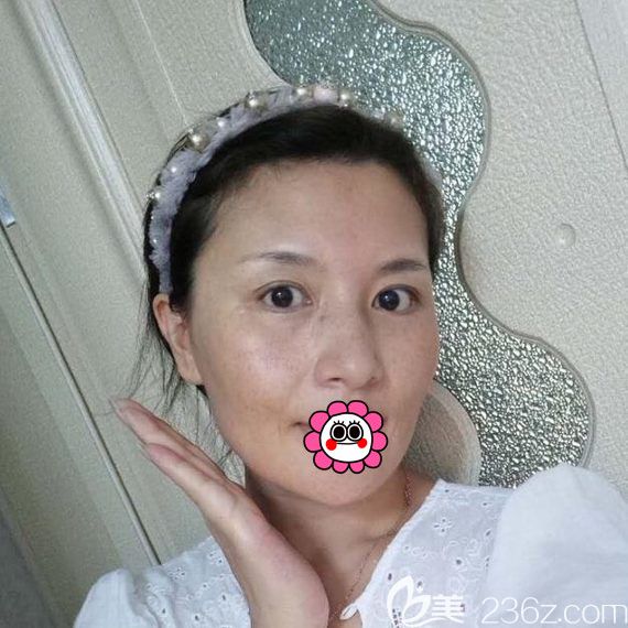 到黑龍江瑞麗脂肪面部填充前 到黑龍江瑞麗脂肪面部填充前