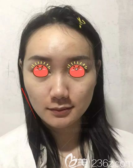 紹興維美李俊霞面部線雕半張臉效果 紹興維美李俊霞面部線雕半張臉效果