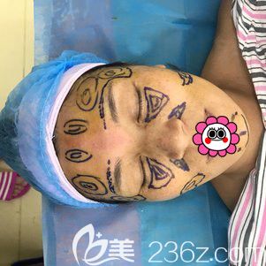 自體脂肪填充面部術中畫線 自體脂肪填充面部術中畫線