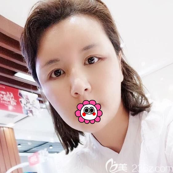 自體脂肪面部填充后10天臉還是有點腫 自體脂肪面部填充后10天臉還是有點腫