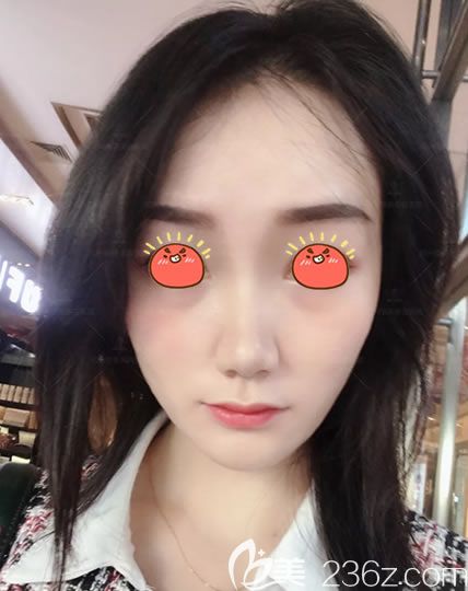 紹興維美整形面部線雕案例 紹興維美整形面部線雕案例