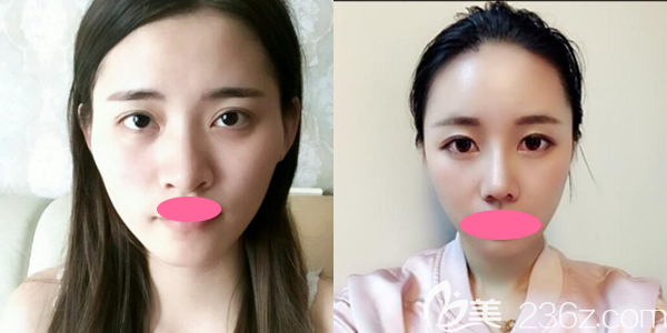 上饒尚美張維華鼻綜合整形一個(gè)月效果圖展示 上饒尚美張維華鼻綜合整形一個(gè)月效果圖展示