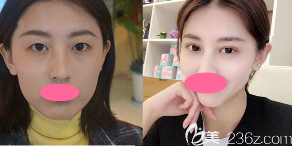 上饒尚美切開(kāi)雙眼皮一個(gè)月效果圖 上饒尚美切開(kāi)雙眼皮一個(gè)月效果圖