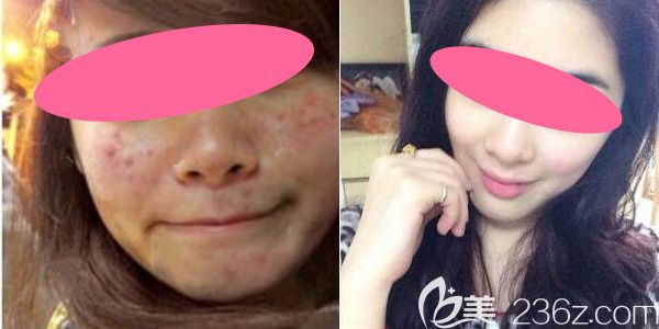上饒尚美激光祛痘兩個(gè)療程效果圖 上饒尚美激光祛痘兩個(gè)療程效果圖